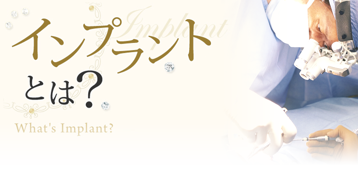 インプラントとは？